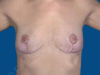 after breast implant removal front view case 4146