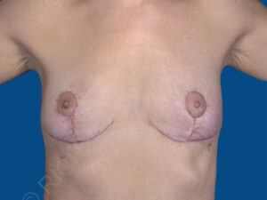 after breast implant removal front view case 4146