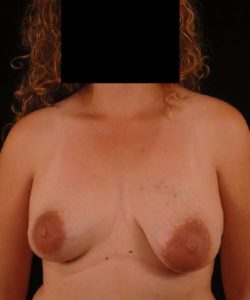 before breast lift with implants front view case 4364
