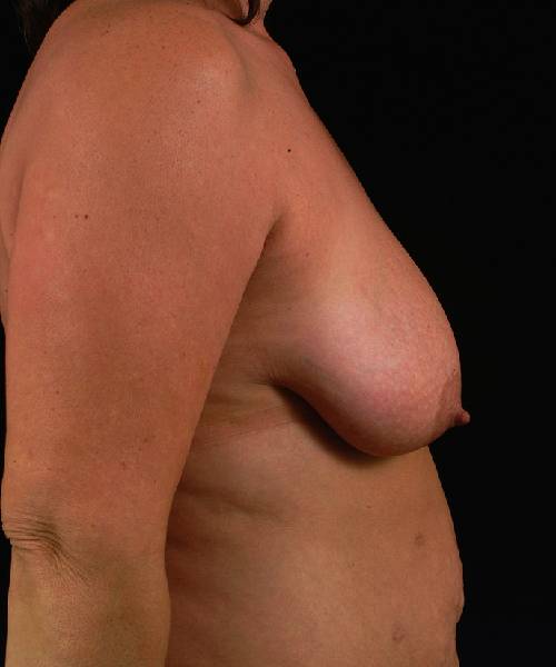 before breast lift with implants right side view case 4369