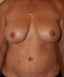 after breast lift with implants front view case 4369