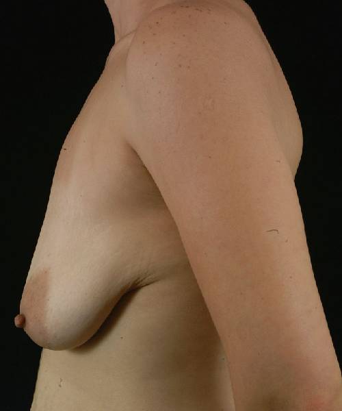 before breast lift with implants left side view case 4374
