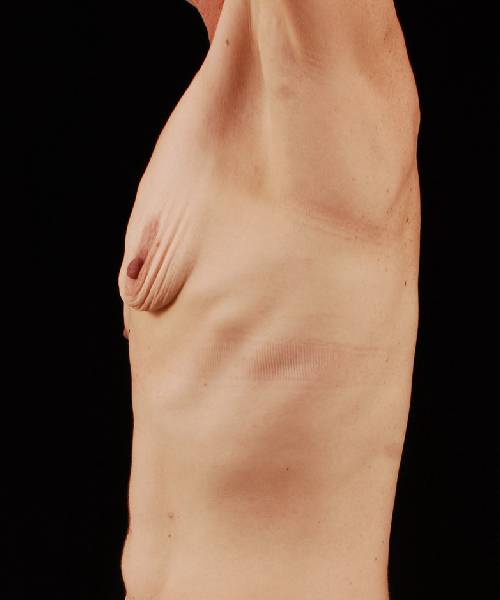 before breast lift with implants left side view case 4383