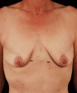 before breast lift with implants front view case 4383