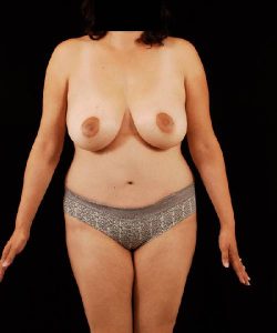 after breast lift with implants front view case 4389