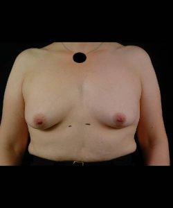 before breast lift with implants front view case 4394
