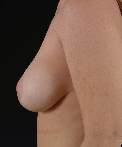 after breast lift with implants left side view case 4399