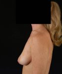 before breast lift with implants left side view case 4399