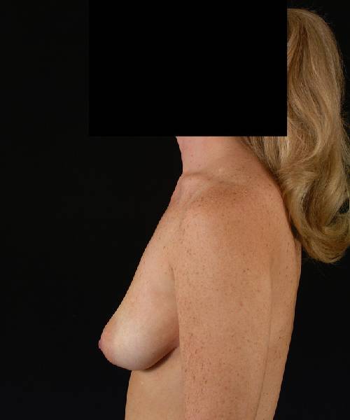 before breast lift with implants left side view case 4399