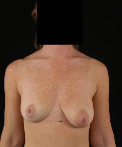 before breast lift with implants front view case 4399