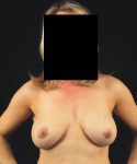 after breast lift with implants front view case 4405