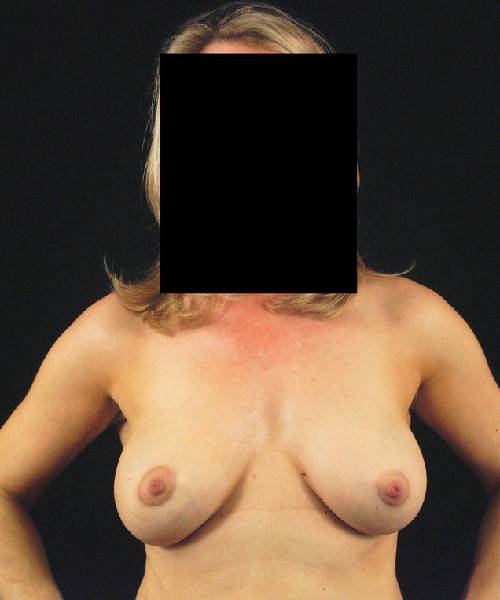 after breast lift with implants front view case 4405