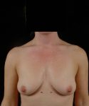 before breast lift with implants front view case 4405