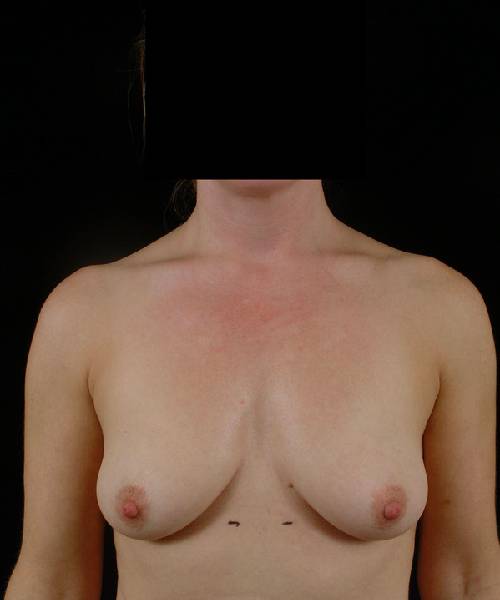 before breast lift with implants front view case 4405