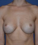 before breast revision front view case 4510