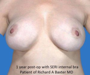 after breast revision front view case 4521