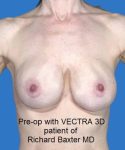 before breast revision front view case 4528