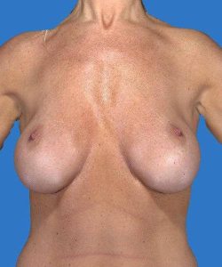 before breast revision surgery front view case 4536