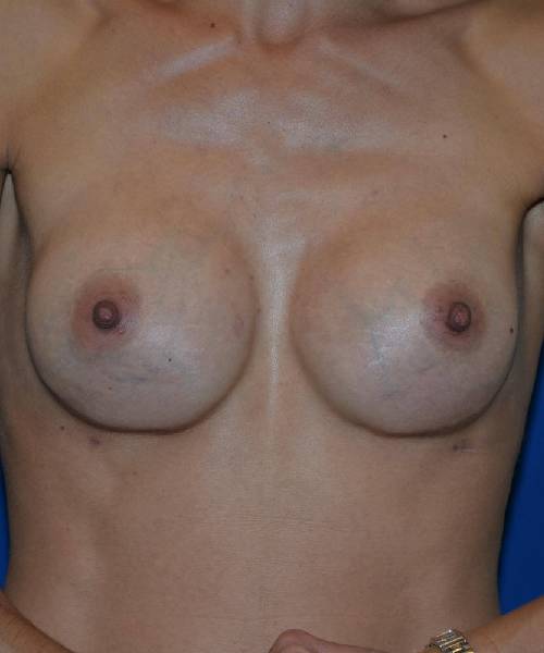 After Breast Revision Surgery Female Patient Front Angle flexed View Case 4539