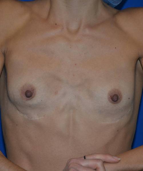 before breast revision front view case 4539