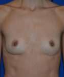 before breast revision surgery front view case 4539