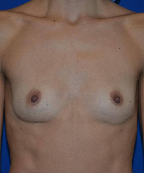 before breast revision surgery front view case 4539