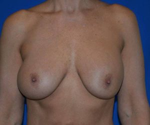 Before Breast Revision Surgery Female Patient Front Angle View Case 4544