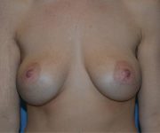 After Breast Revision Surgery Female Patient Front Angle View Case 4551