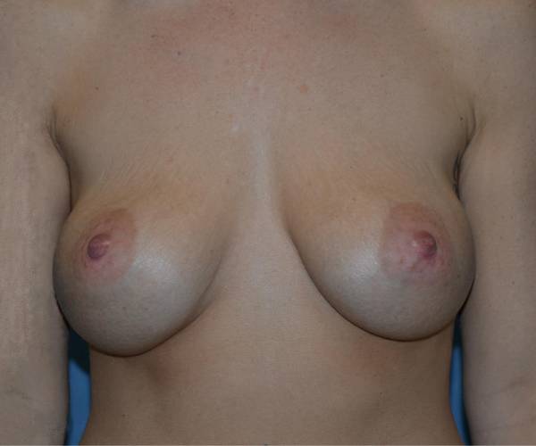 After Breast Revision Surgery Female Patient Front Angle View Case 4551