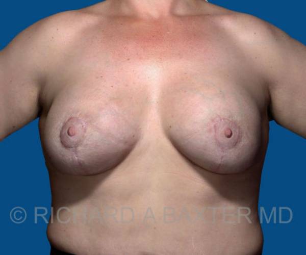 After Breast Revision Surgery Female Patient Front Angle View Case 4561
