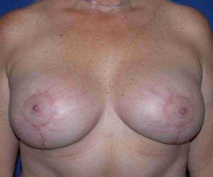 After Breast Revision Surgery Female Patient Front Angle View Case 4576