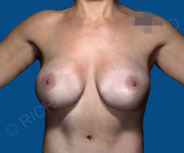After Breast Revision Surgery Female Patient Front Angle View Case 4591