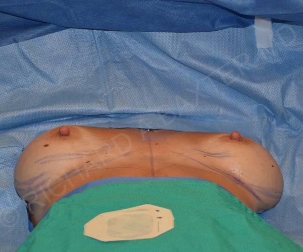 Before Breast Revision Surgery Female Patient OR View Case 4591