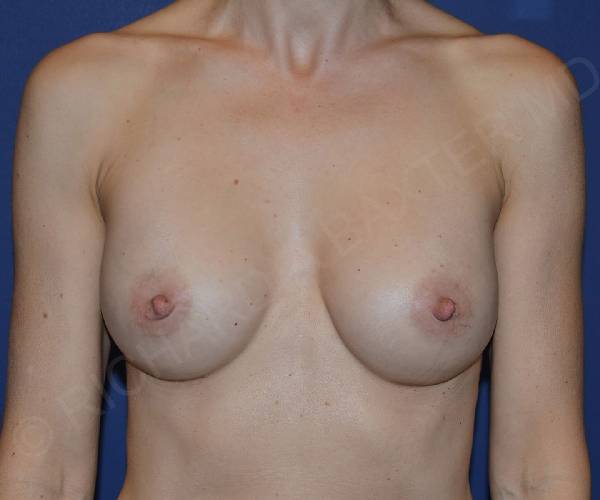 Before Breast Revision Surgery Female Patient Front Angle View Case 4602