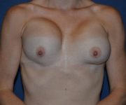 Before Breast Revision Surgery Female Patient Front Angle flexing View Case 4612