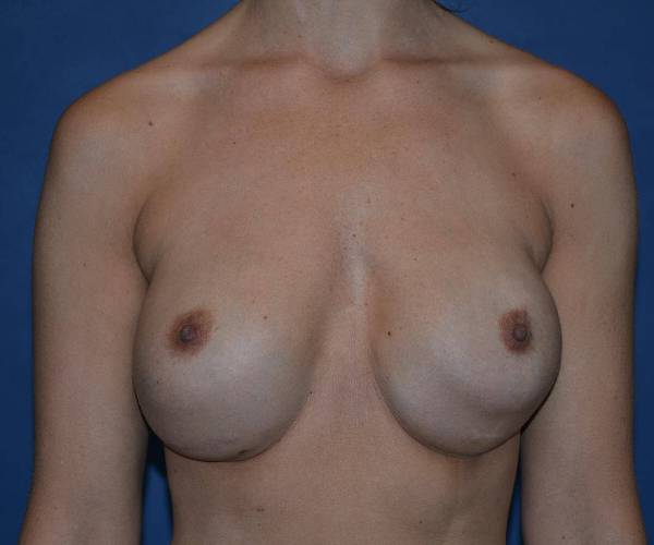 Before Breast Revision Surgery Female Patient Front Angle View Case 4623
