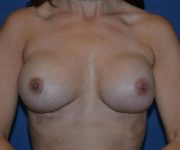After Breast Revision Surgery Female Patient Front Angle flexed View Case 4623