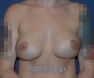 After Breast Revision Surgery Female Patient Front Angle flexed View Case 4630