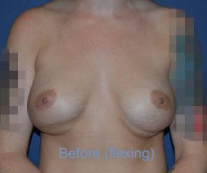 Before Breast Revision Surgery Female Patient Front Angle flexed View Case 4630