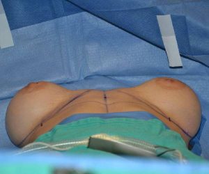 Before Breast Revision Surgery Female Patient OR View Case 4654