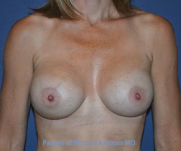 After Breast Revision Surgery Female Patient Front Angle View Case 4657