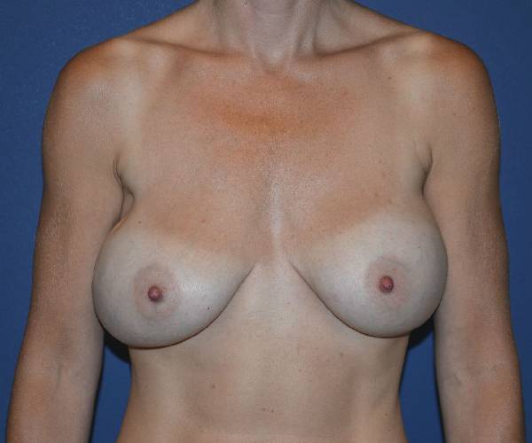 Before Breast Revision Surgery Female Patient Front Angle View Case 4657