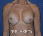 Before Breast Revision Surgery Female Patient Front Angle View Case 4667