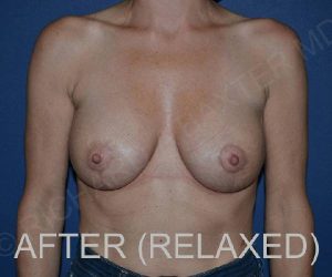 After Breast Revision Surgery Female Patient Front Angle View Case 4676