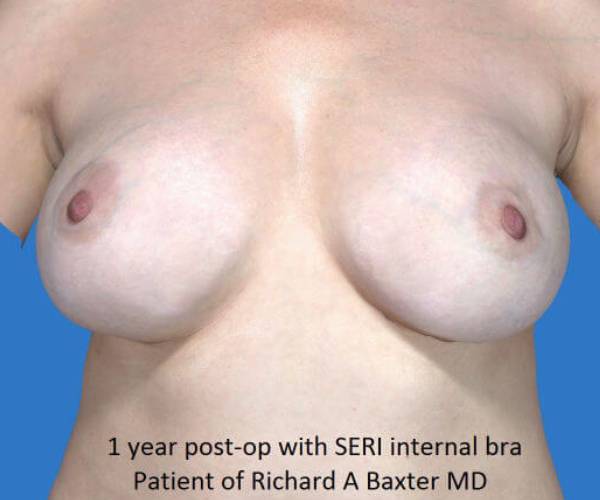 after breast revision front view case 4521