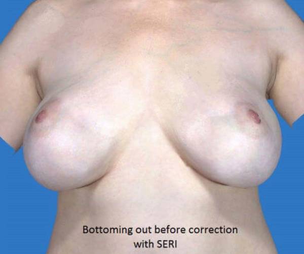 before breast revision front view case 4521