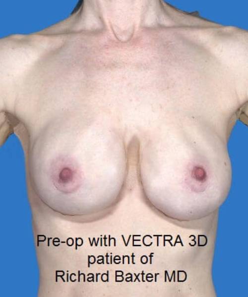 before breast revision front view case 4528