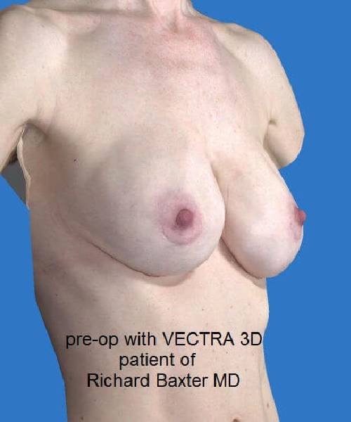 before breast revision right angle view case 4528