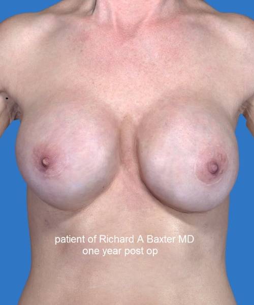 after breast revision surgery front view case 4533
