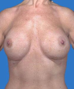 after breast revision surgery front view case 4536